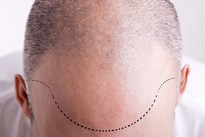 Haartransplantation | © panthermedia.net /ruigsantos