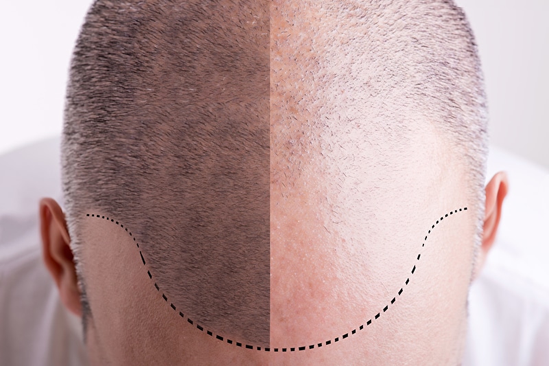 Haarausfall - vor und nach | © panthermedia.net / ruigsantos